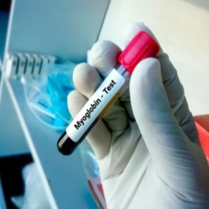 Myoglobin: The Ultra-Early Sentinel of Myocardial Injury