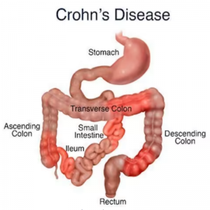 Do you know  about Crohn’s Disease?