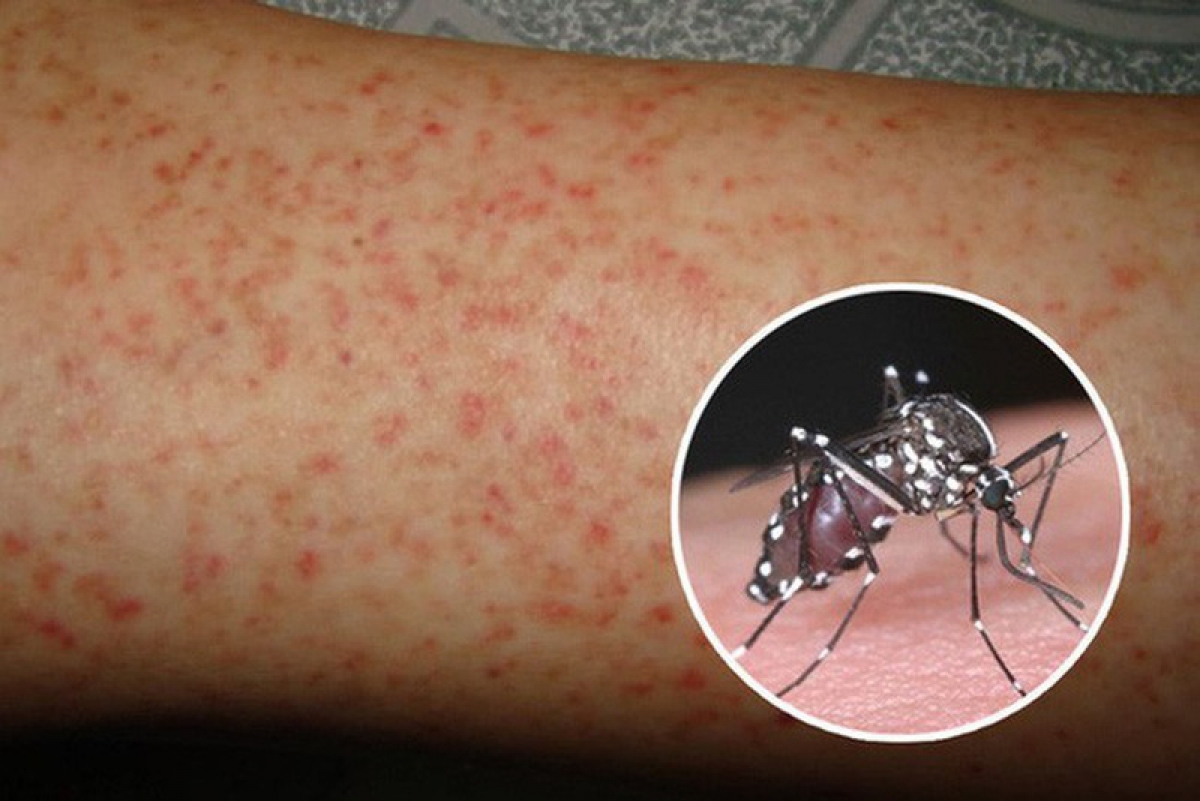 What do you know about Dengue Fever?