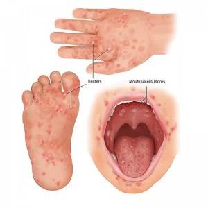 Do you know about Hand, foot and mouth disease ?